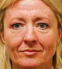 Lifting Cervico-facial 