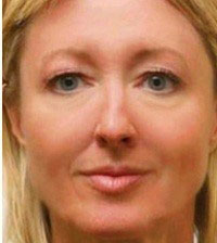 Lifting Cervico-facial