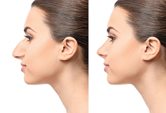 Rhinoplastie Rhinoplastie