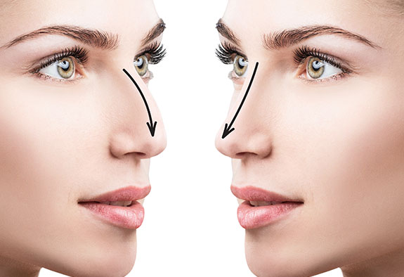 Rhinoplastie Rhinoplastie