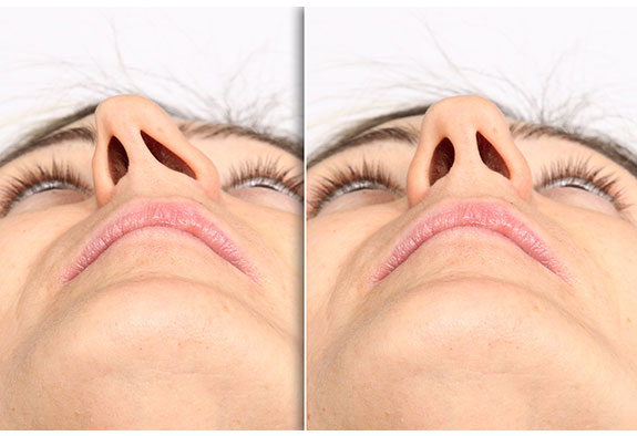 Rhinoplastie Rhinoplastie