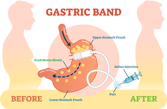 La gastroplastie par anneau gastrique