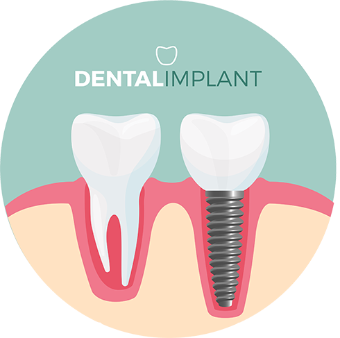 implant dentaire